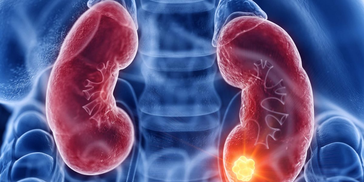 3d rendered medically accurate illustration of kidney cancer